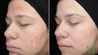 Acne Before & After Gallery - Patient 5640906 - Image 1