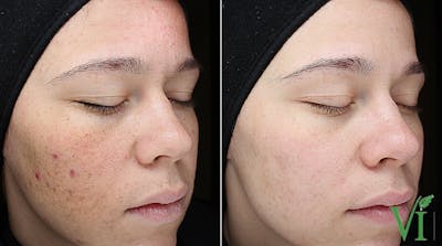 VI Peel Before & After Gallery - Patient 705817 - Image 2