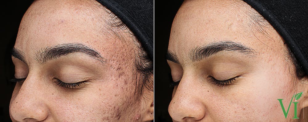 Chemical Peels Before & After Gallery - Patient 164917 - Image 1