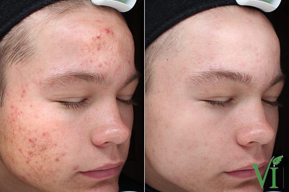 VI Peel Before & After Gallery - Patient 705817 - Image 1