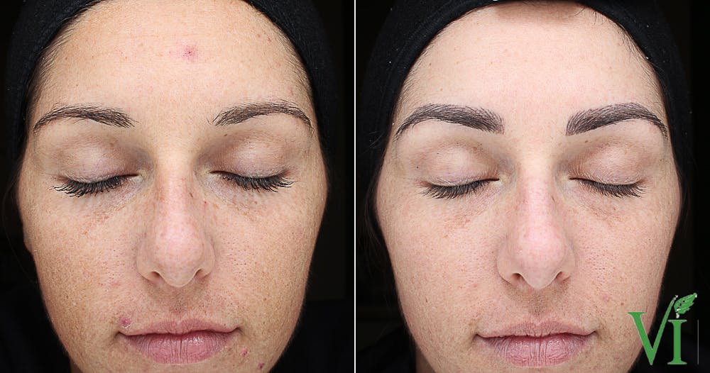 Tone Texture Before & After Gallery - Patient 5640912 - Image 1