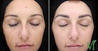 VI Peel Before & After Gallery - Patient 345885 - Image 1