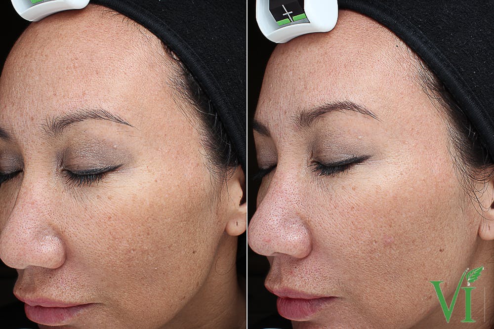 HQ Plus Before & After Gallery - Patient 5640916 - Image 1