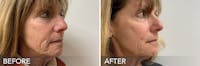 Dermal Fillers Before & After Gallery - Patient 15239598 - Image 1
