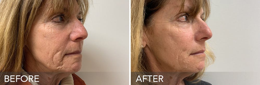 Dermal Fillers Before & After Gallery - Patient 15239598 - Image 1