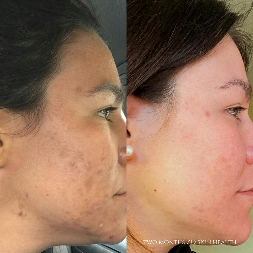 ZO Skin Health Before & After Gallery - Patient 19056409 - Image 1