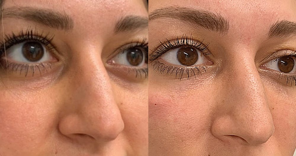 Dermal Fillers Before & After Gallery - Patient 19339303 - Image 1