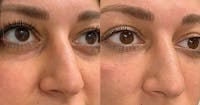Dermal Fillers Before & After Gallery - Patient 19339303 - Image 1
