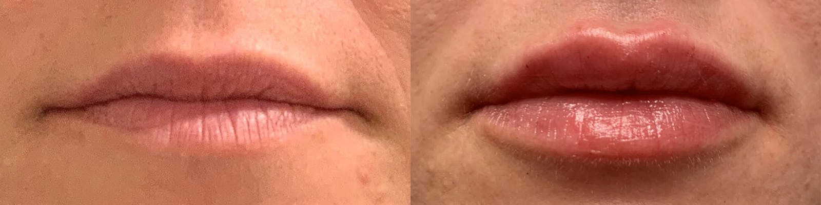 Lip Enhancement Before & After Gallery - Patient 19056396 - Image 1