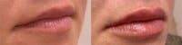 Lip Enhancement Before & After Gallery - Patient 20050587 - Image 1