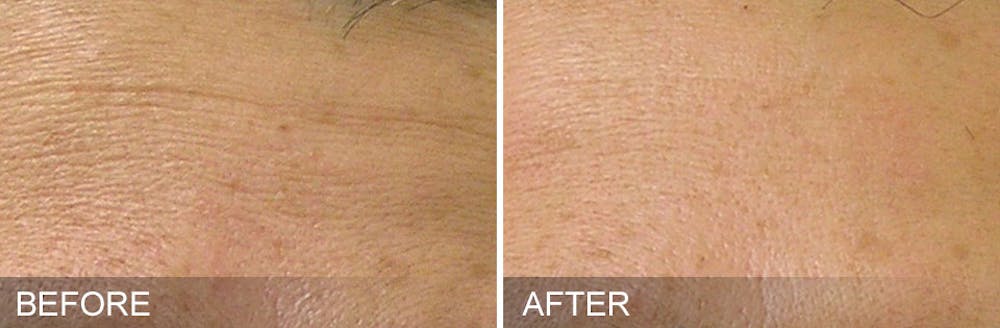 Hydrafacial Before & After Gallery - Patient 31172719 - Image 1