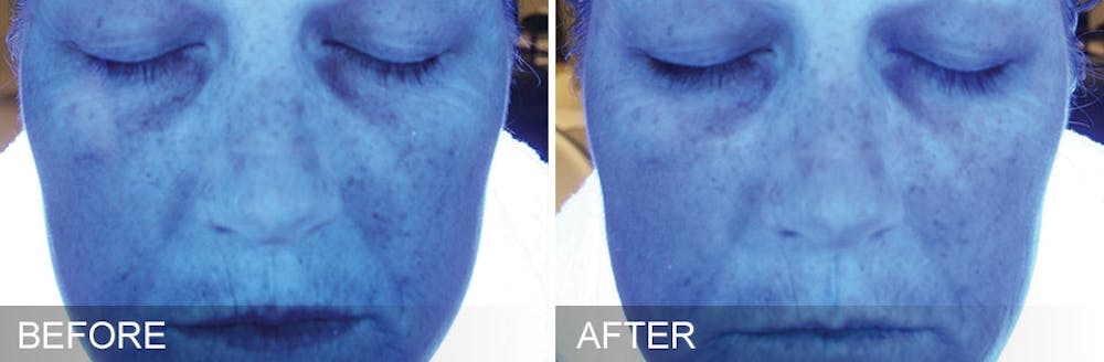 Hydrafacial Before & After Gallery - Patient 31172723 - Image 1