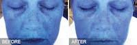 Hydrafacial Before & After Gallery - Patient 31172723 - Image 1