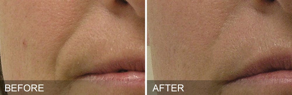 Hydrafacial Before & After Gallery - Patient 31172729 - Image 1
