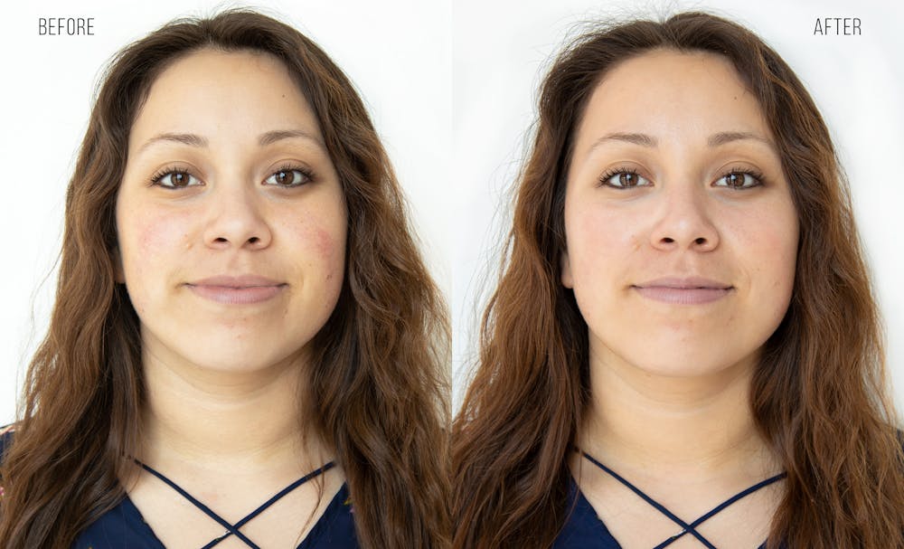 Hydrafacial Before & After Gallery - Patient 31172813 - Image 1