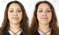 Hydrafacial Before & After Gallery - Patient 31172813 - Image 1