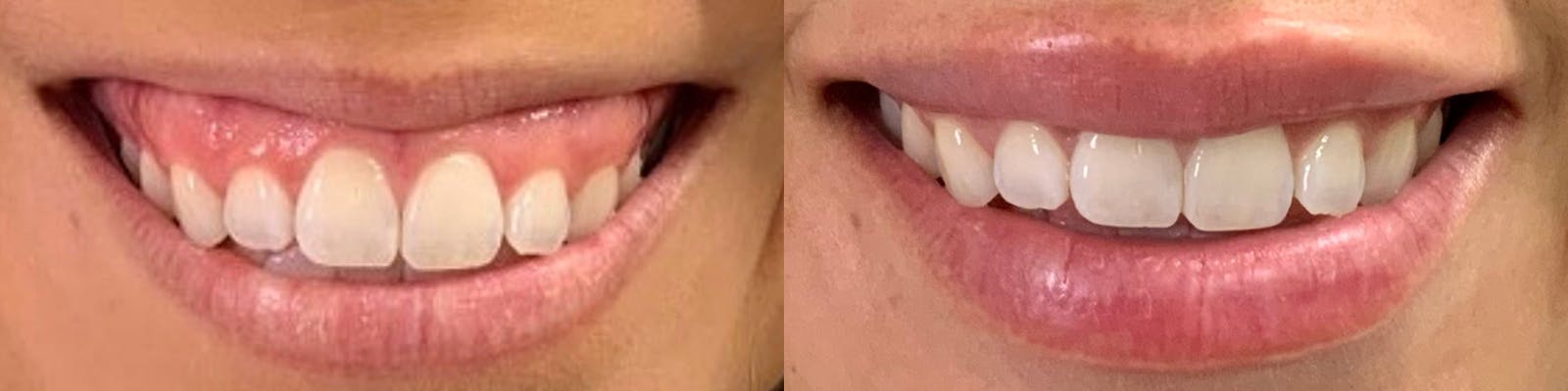 Lip Enhancement Before & After Gallery - Patient 31204320 - Image 1