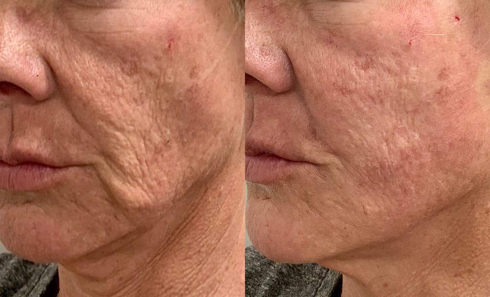PDO Thread Lift Before & After Photos Aesthera MedSpa