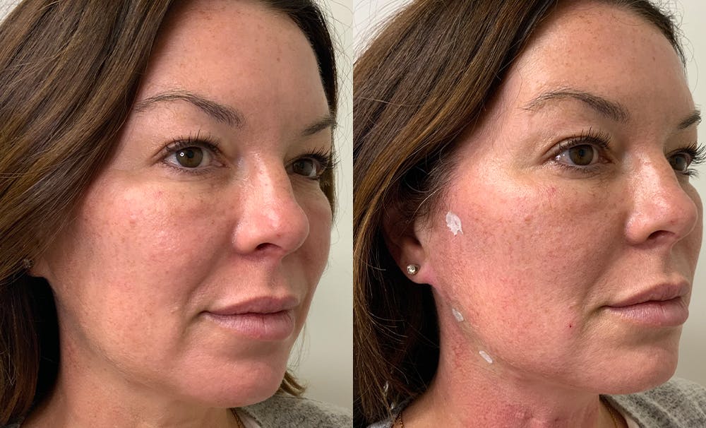 Patient 31208491 Pdo Thread Lift Before And After Photos Aesthera Medspa