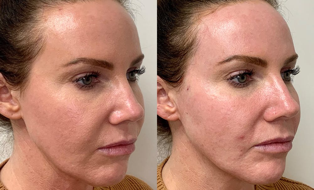 PDO Thread Lift Before & After Photos Aesthera MedSpa