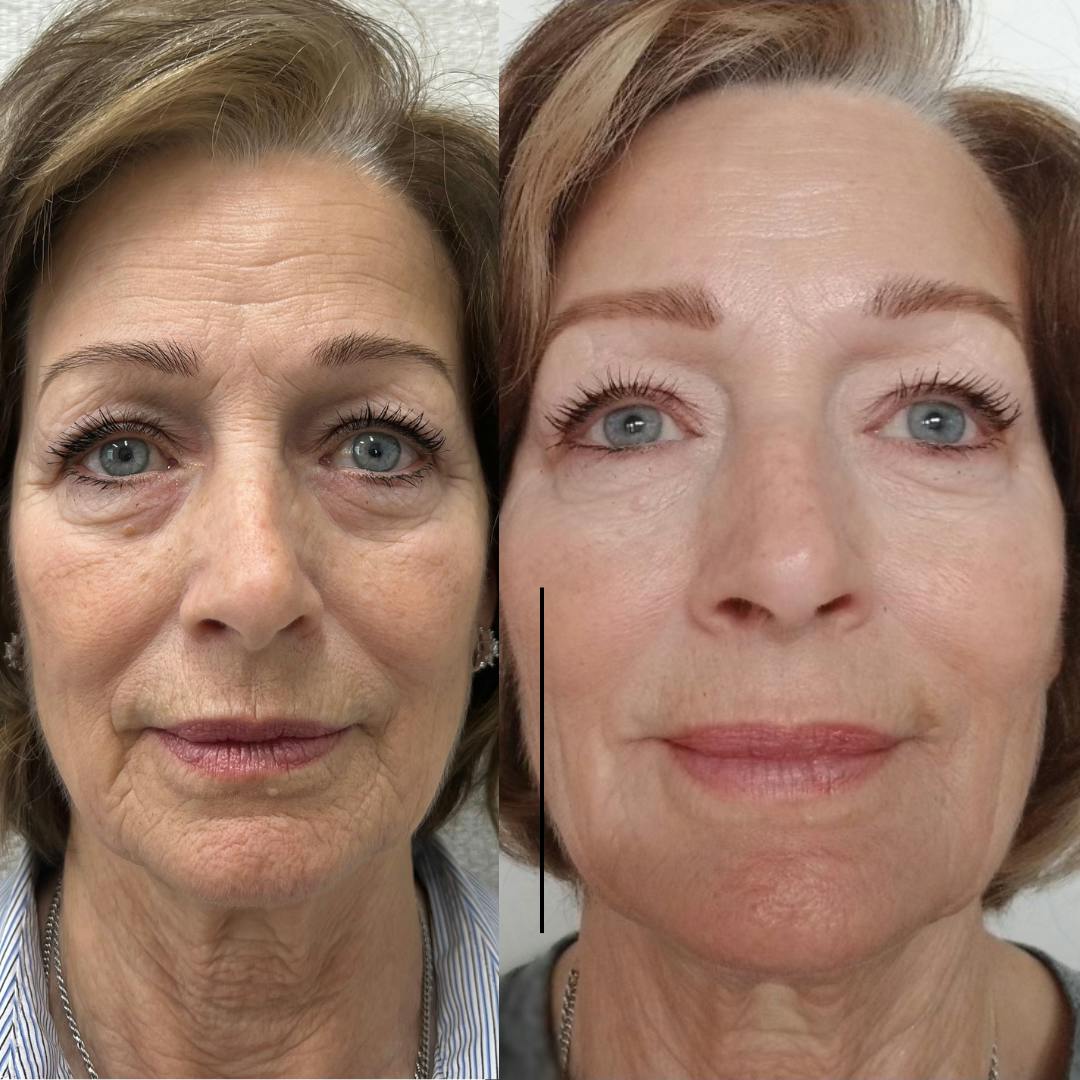Botox Before & After Gallery - Patient 118484 - Image 1