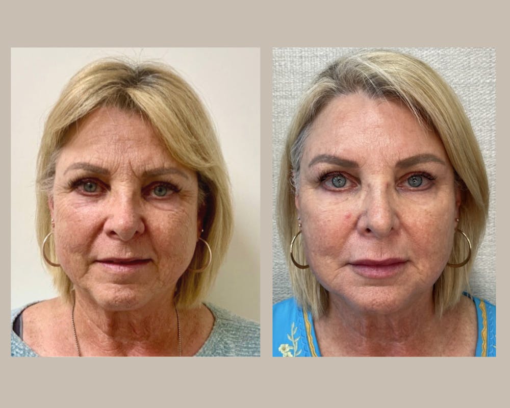Dermal Fillers Before & After Gallery - Patient 342681 - Image 1