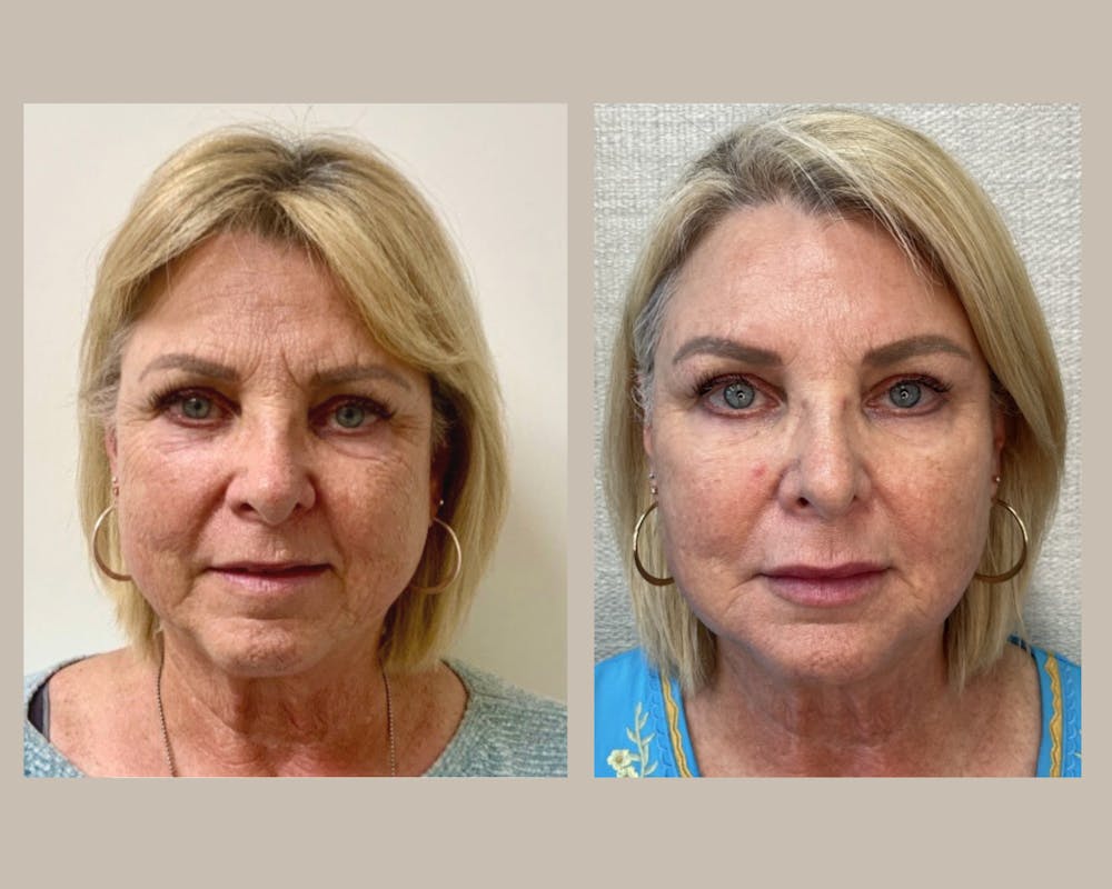 Botox Before & After Gallery - Patient 241395 - Image 1