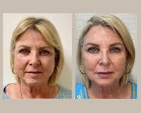 Botox Before & After Gallery - Patient 241395 - Image 1