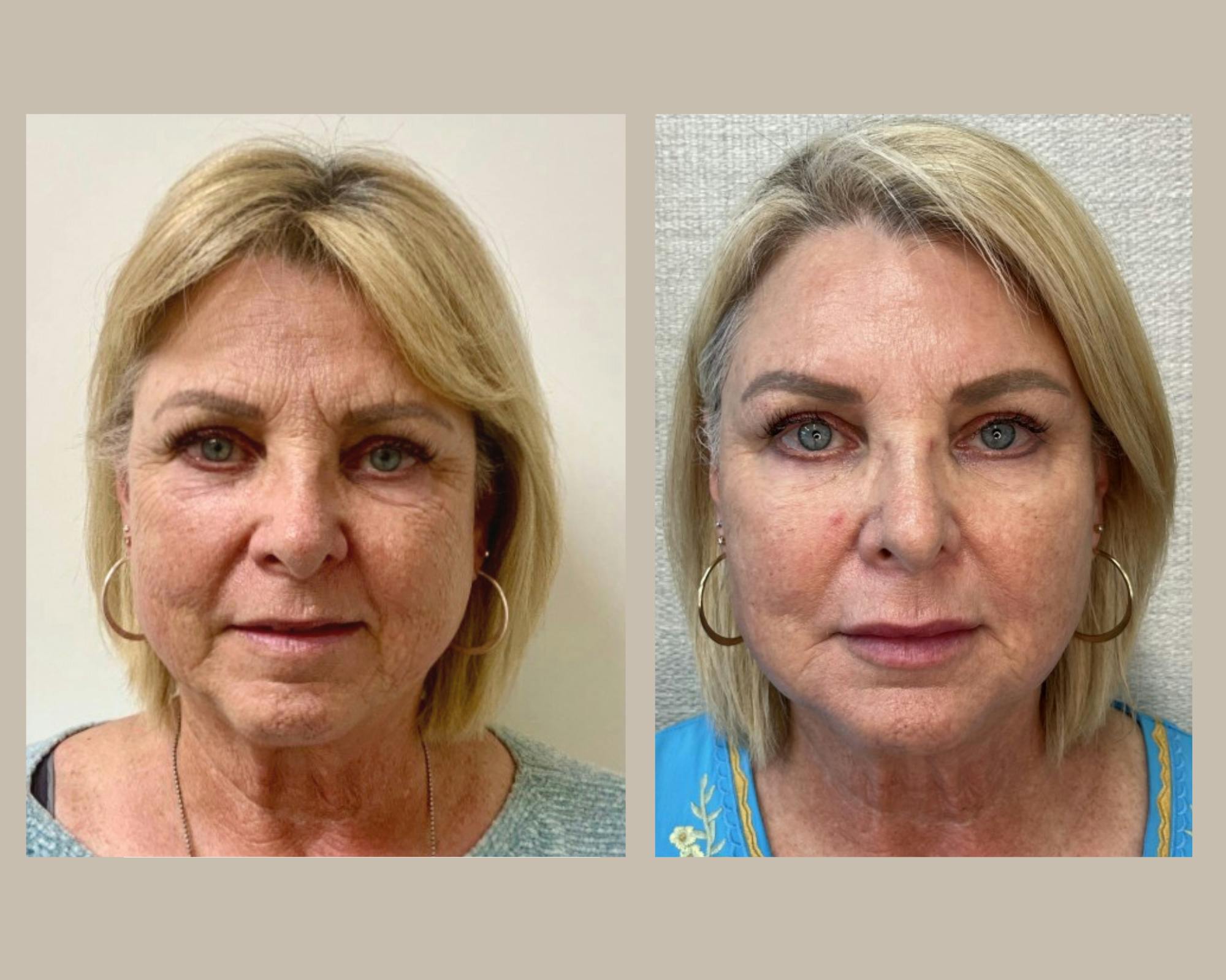 Botox Before & After Gallery - Patient 241395 - Image 1