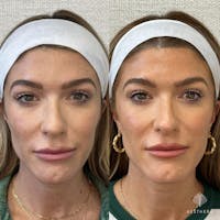 Sculptra Before & After Gallery - Patient 331599 - Image 1