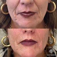 Sculptra Before & After Gallery - Patient 349191 - Image 1