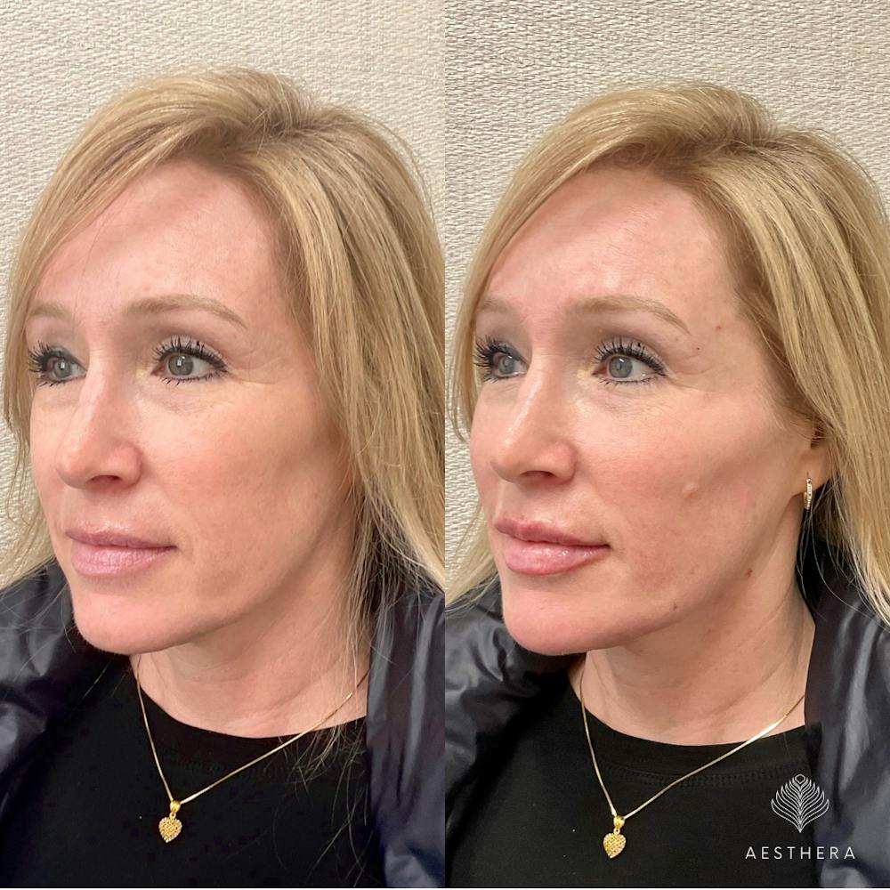 Dermal Fillers Before & After Gallery - Patient 744175 - Image 1