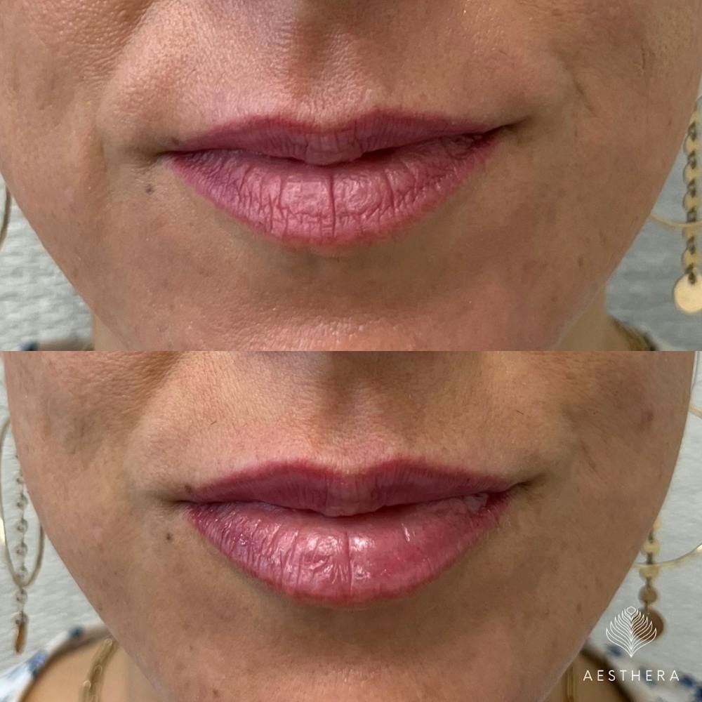 Dermal Fillers Before & After Gallery - Patient 342300 - Image 1