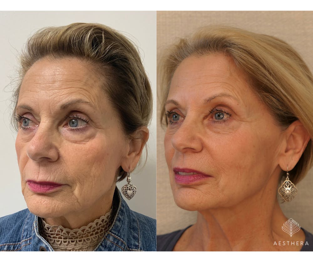 PDO Thread Lift Before & After Gallery - Patient 244360 - Image 1
