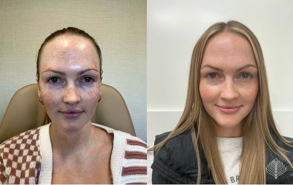BBL Before & After Gallery - Patient 329173 - Image 1