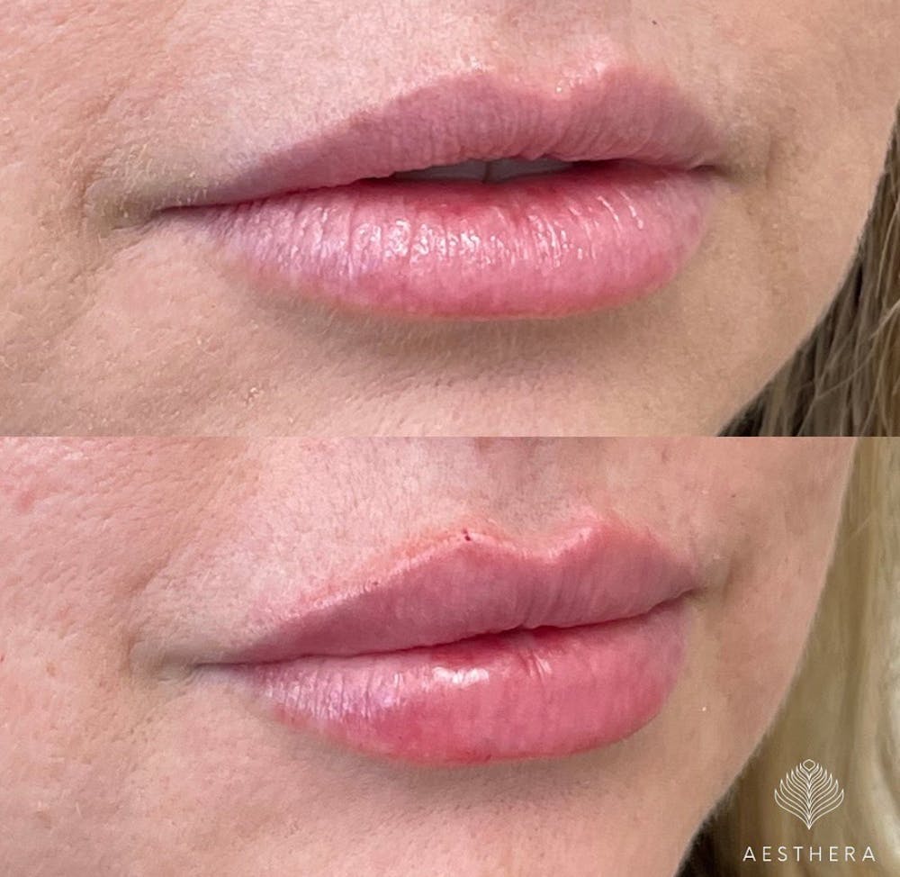 Lip Enhancement Before & After Gallery - Patient 117074 - Image 2