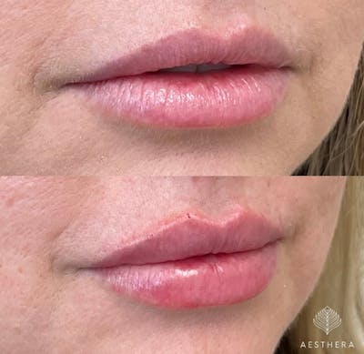 Lip Enhancement Before & After Gallery - Patient 117074 - Image 2