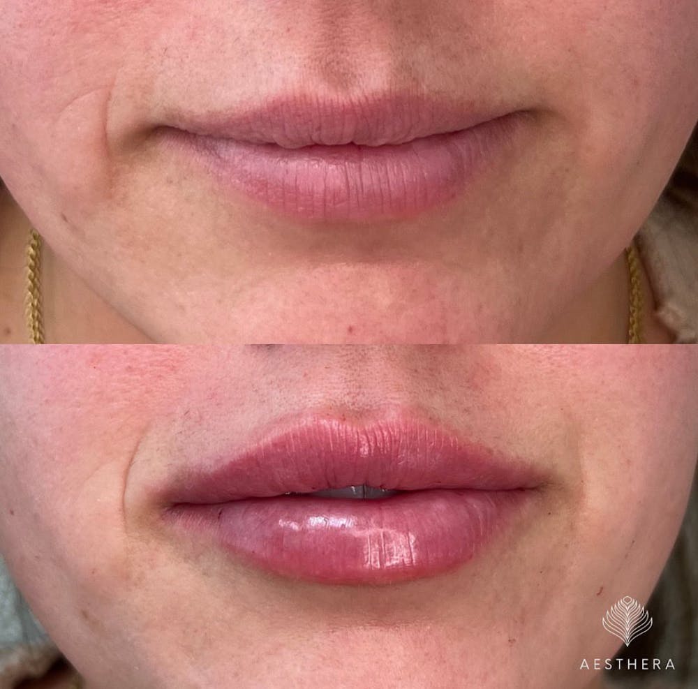 Lip Enhancement Before & After Gallery - Patient 117074 - Image 1