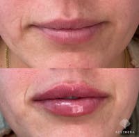 Lip Enhancement Before & After Gallery - Patient 117074 - Image 1