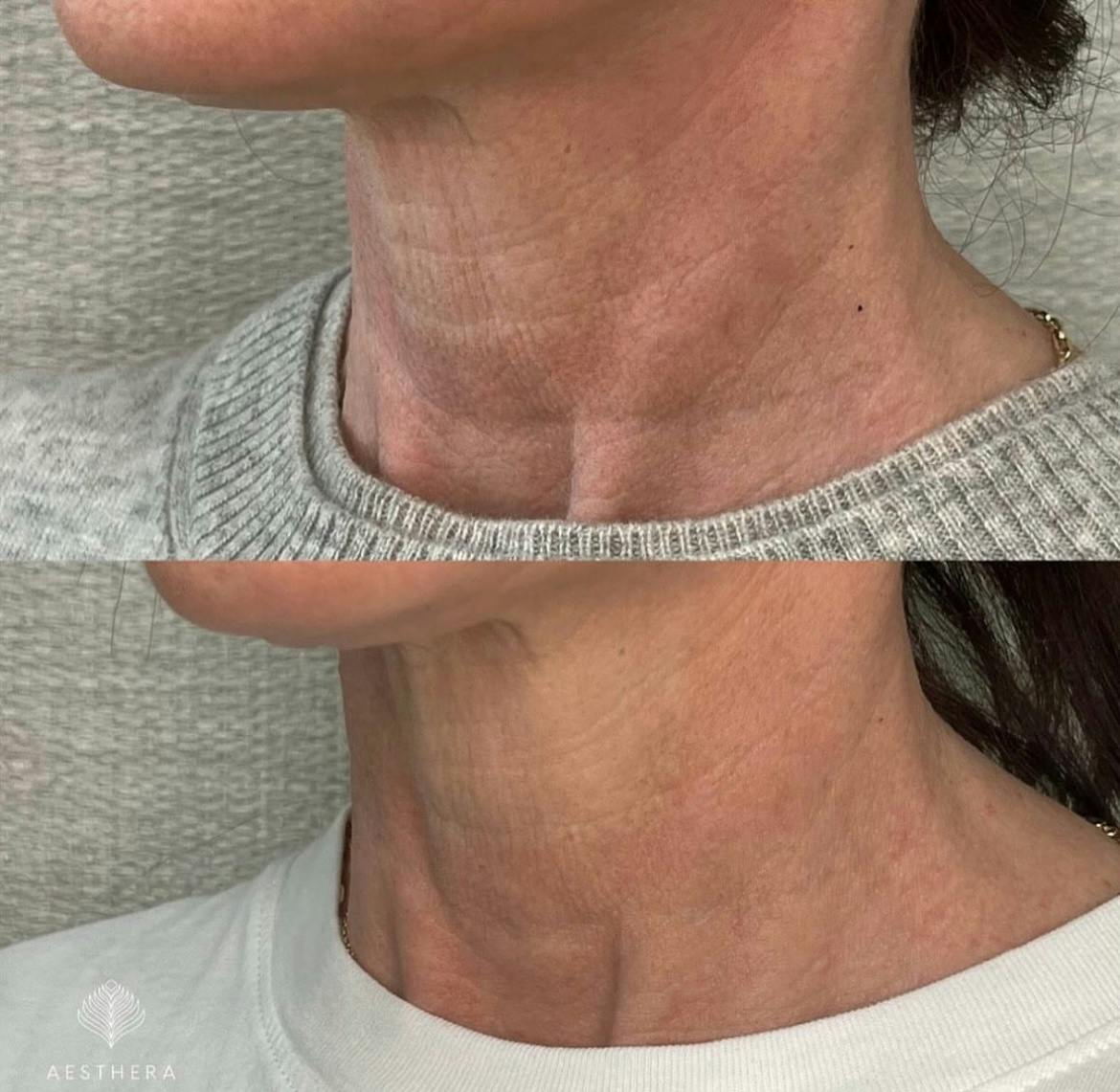 Hyper-diluted Radiesse  Before & After Gallery - Patient 337076 - Image 1