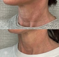 Hyper-diluted Radiesse  Before & After Gallery - Patient 337076 - Image 1