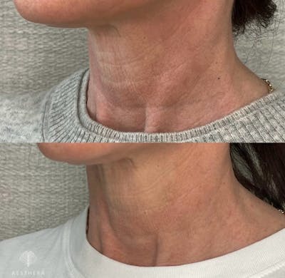 Hyper-diluted Radiesse  Before & After Gallery - Patient 384362 - Image 2