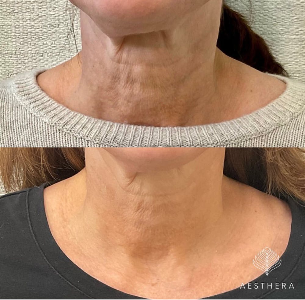 Hyper-diluted Radiesse  Before & After Gallery - Patient 384362 - Image 1