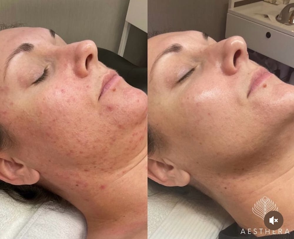Chemical Peels Before & After Gallery - Patient 126208 - Image 1