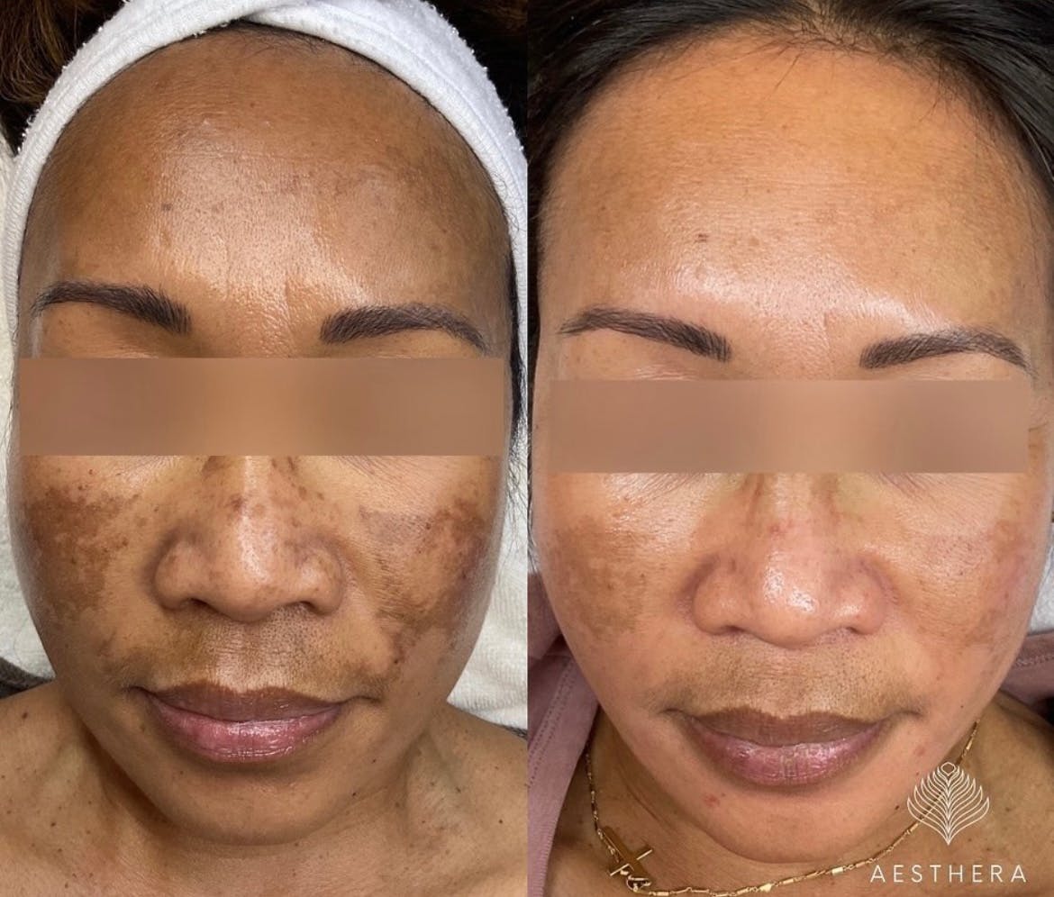 Chemical Peels Before & After Gallery - Patient 183419 - Image 1