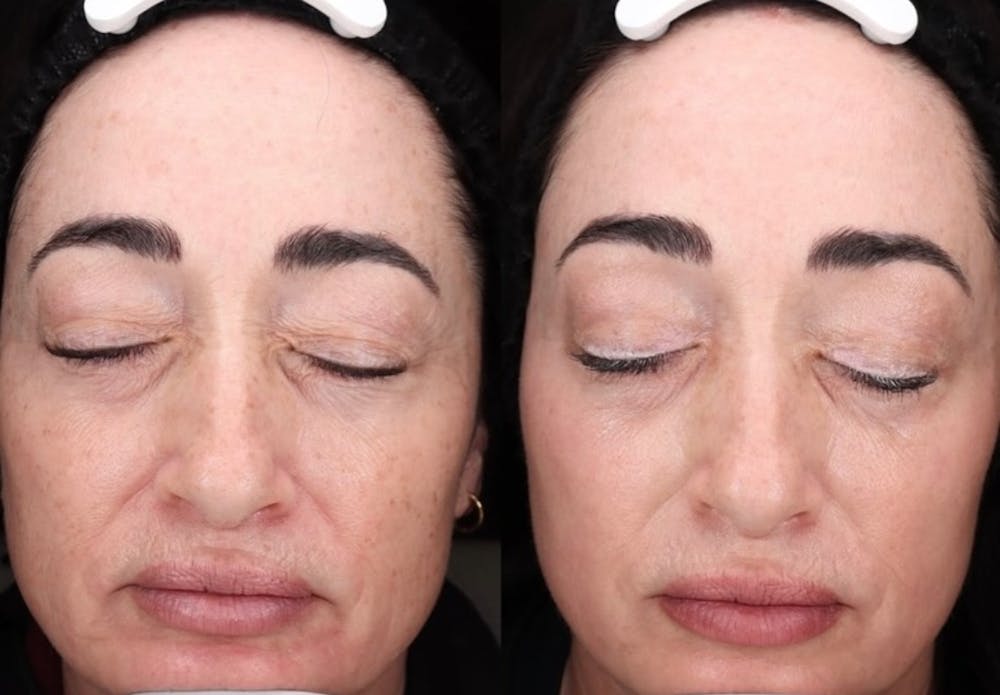Halo Before & After Gallery - Patient 251607 - Image 1