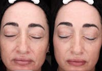 Halo Before & After Gallery - Patient 251607 - Image 1