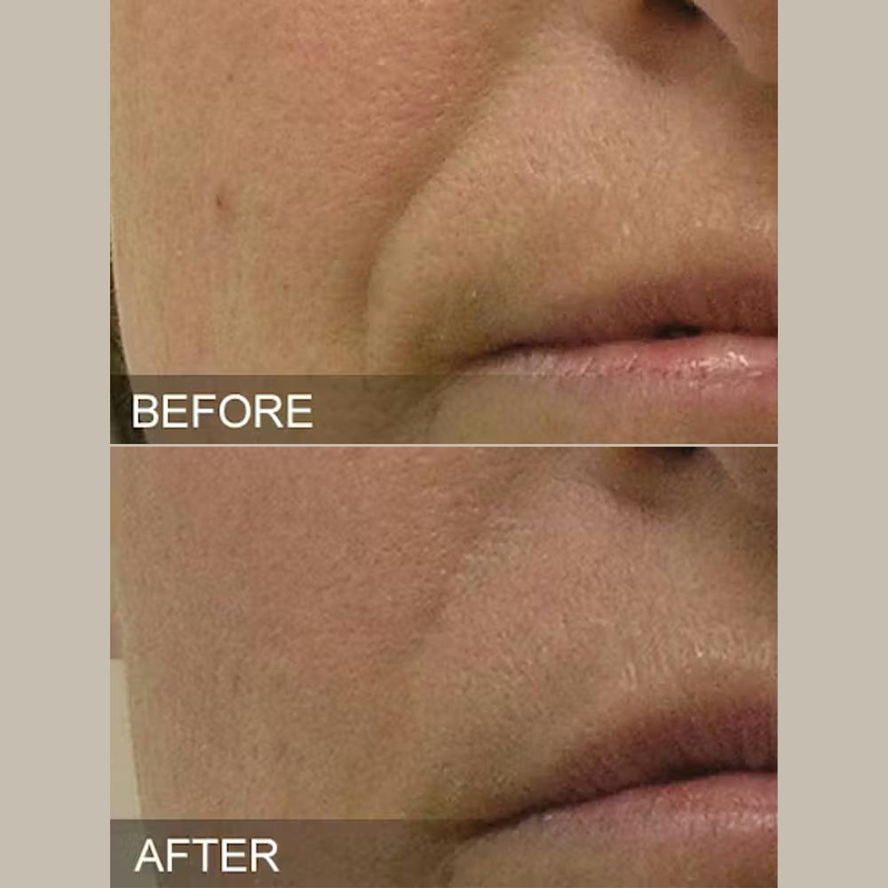 SkinPen Microneedling Before & After Gallery - Patient 5698317 - Image 1