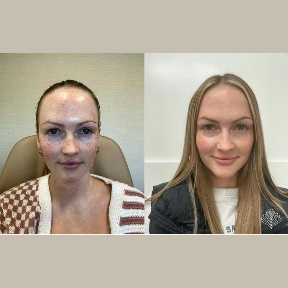 BBL Before & After Gallery - Patient 329173 - Image 1