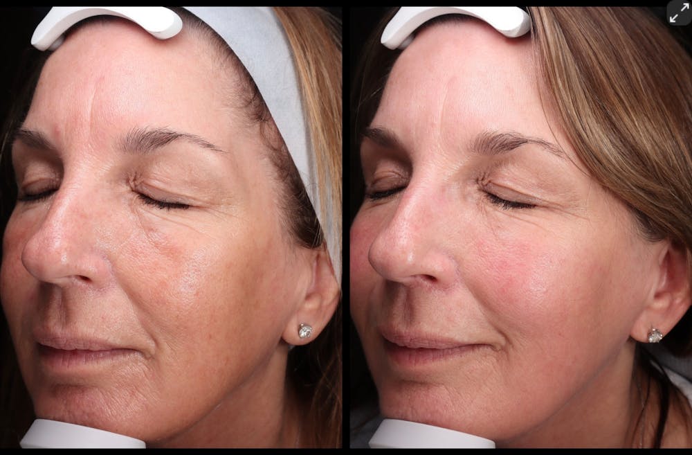 BBL Before & After Gallery - Patient 206787 - Image 3